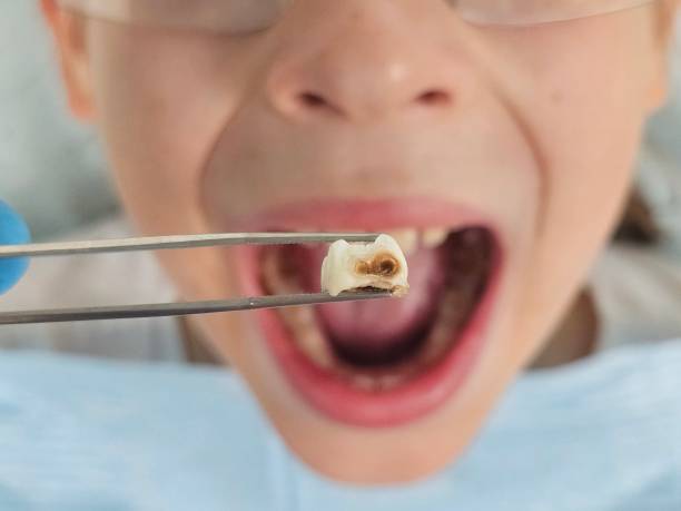 Best Emergency Broken Tooth Repair in USA